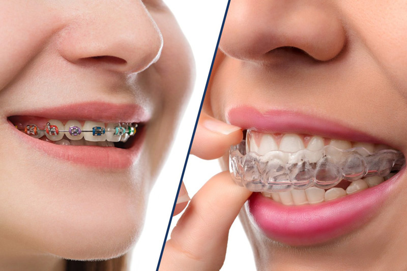 Woman wearing Braces and Woman wearing Invisalign