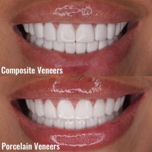 Read more about the article Composite vs Porcelain Veneers