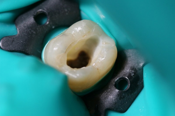 Example of Cleaning Root Canal
