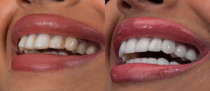 Hollywood Smile Transformation